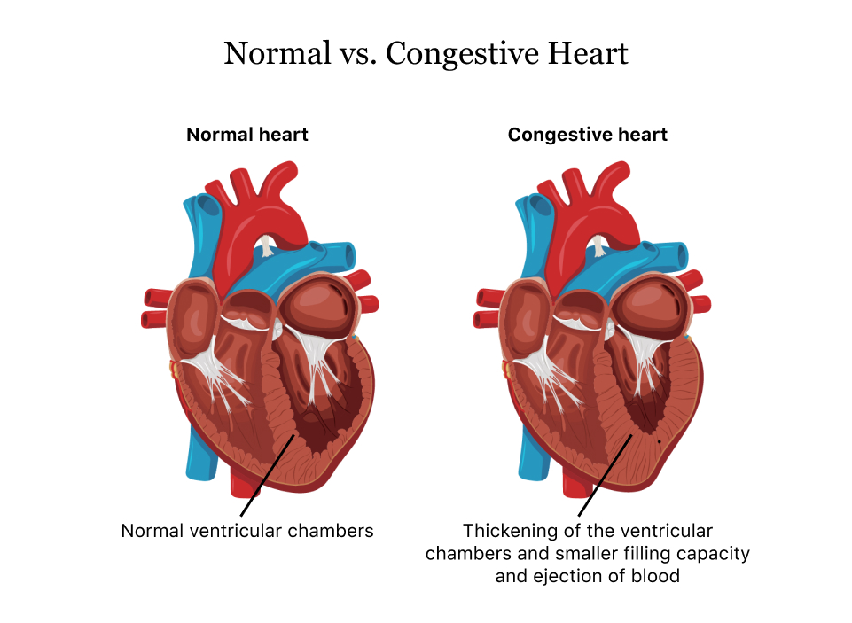 chf-adalah-pengertian-gejala-dan-penyebabnya-drharryfisch